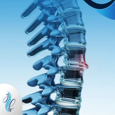 الشفاء من الانزلاق الغضروفي