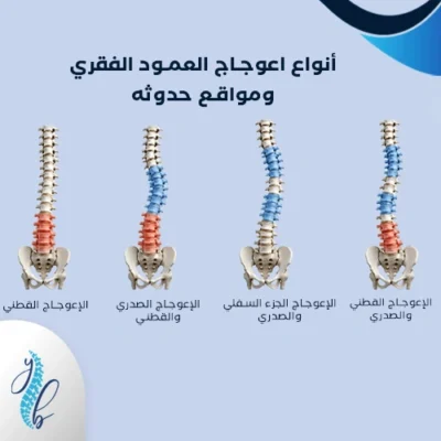خطورة اعوجاج العمود الفقري