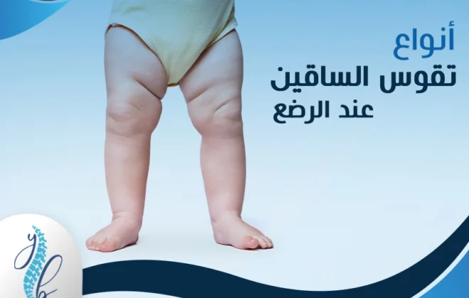 تقوس الساقين عند الرضع