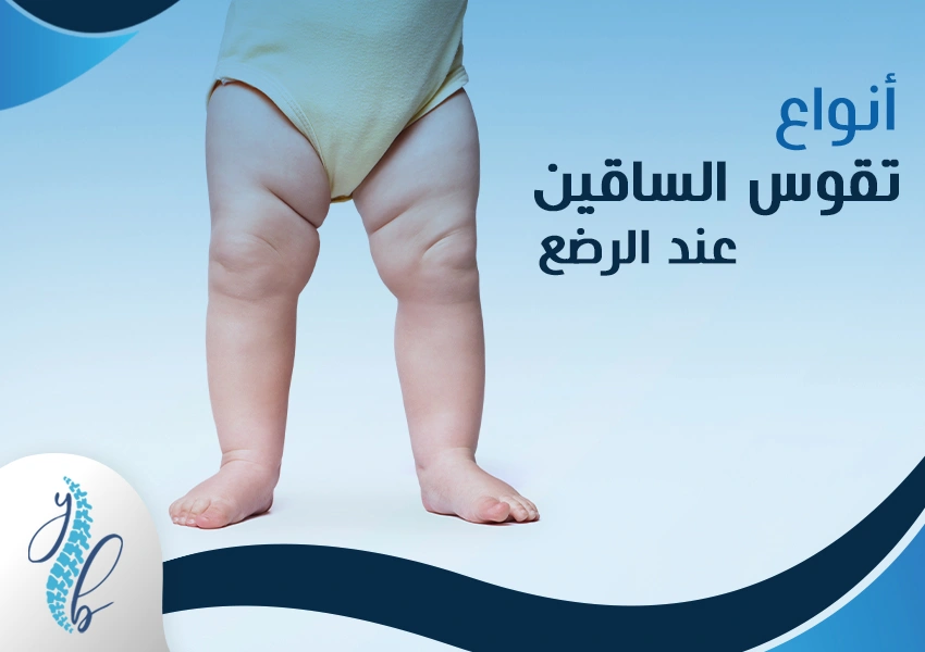 تقوس الساقين عند الرضع