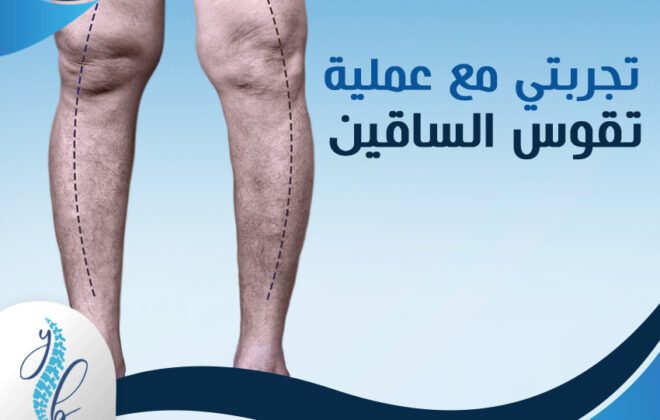 تجربتي مع عمليه تقوس الساقين