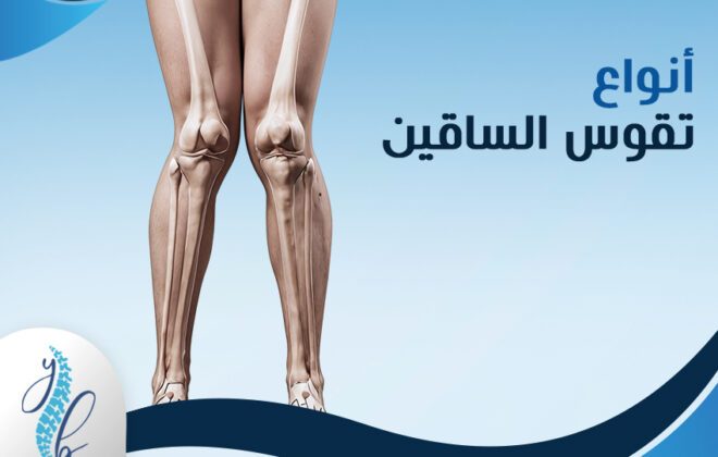 علاج تقوس الساقين عند الاطفال