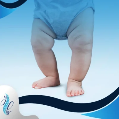 تقوس الساقين عند الرضع