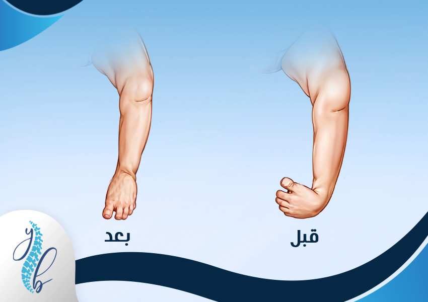 القدم الحنفاء بعد الجبس