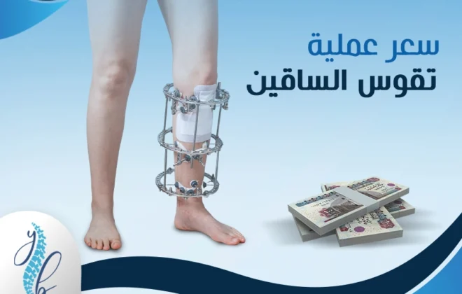 سعر عملية تقوس الساقين