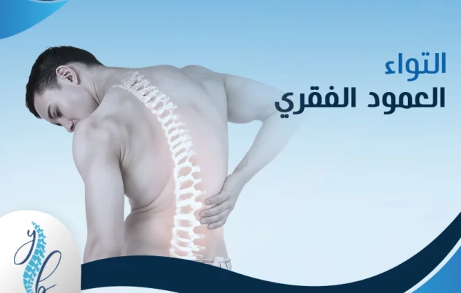 التواء العمود الفقري