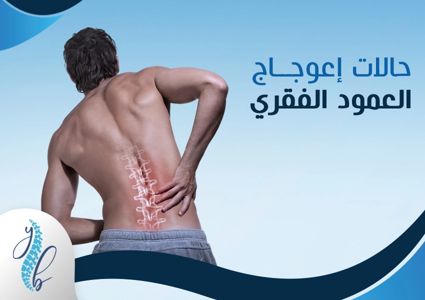 حالات اعوجاج العمود الفقري