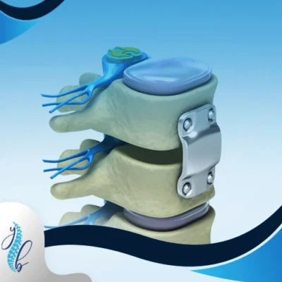 الحمل بعد عملية تثبيت الفقرات 