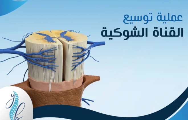 عملية توسيع القناة الشوكية