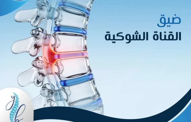 ضيق القناة الشوكية