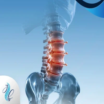 أعراض خشونة العمود الفقري